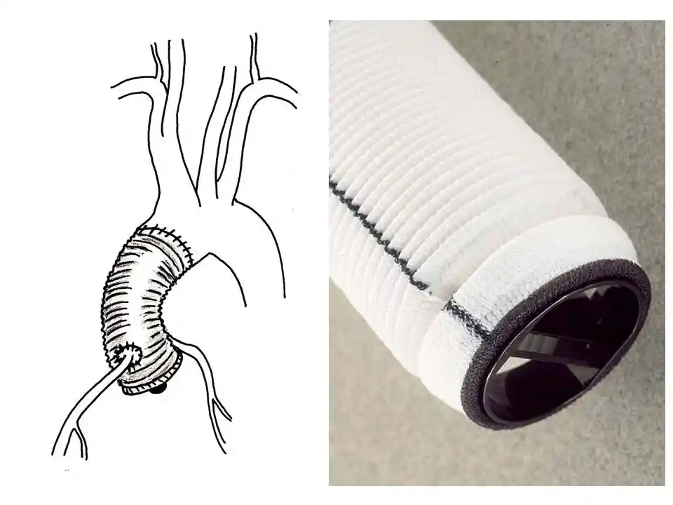 Intervention de Bentall