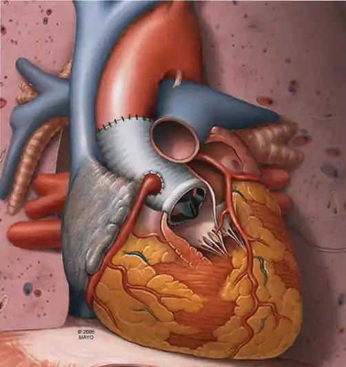 Réimplantation (Tirone David)