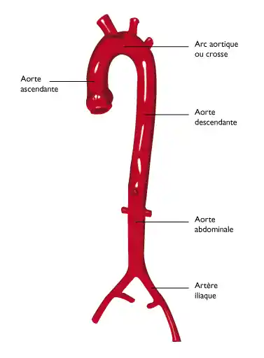Anévrisme de l’aorte ascendante