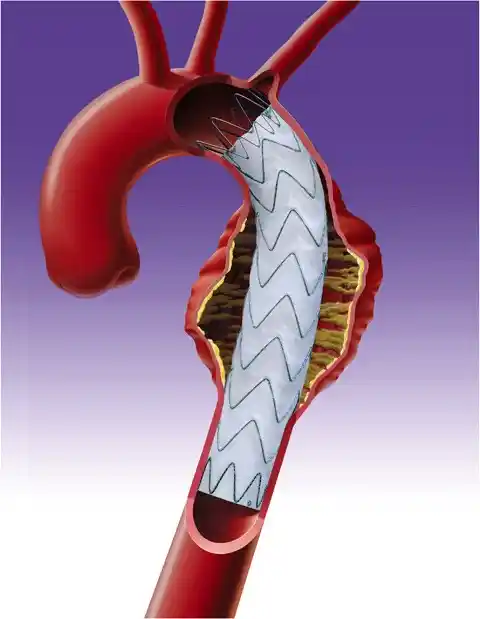 Endoprothèse aortique