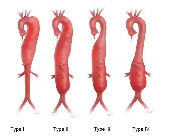 Anévrismes thoraco-abdominaux (classification de Crawford)