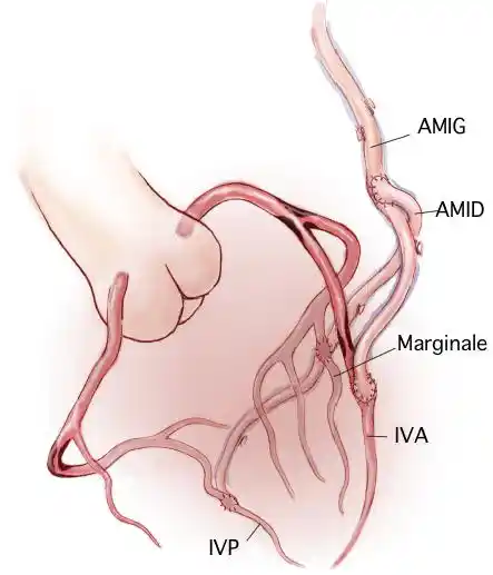 Pontage mammaire interne