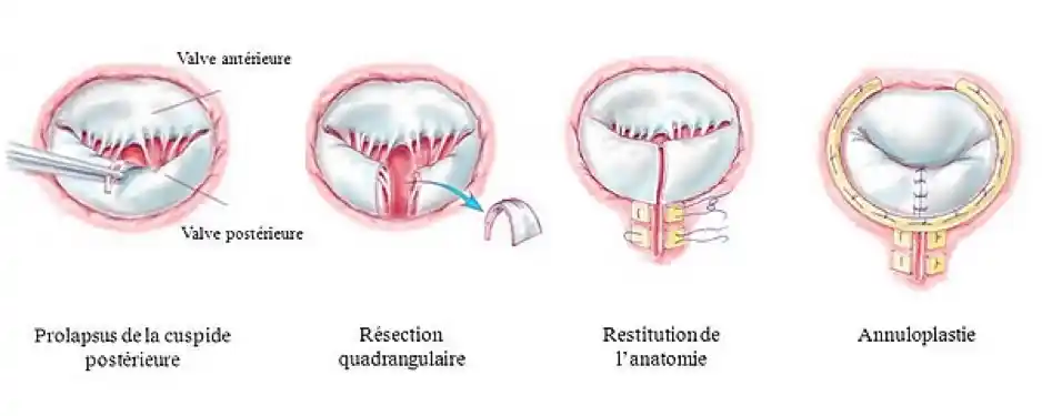 Plastie valvulaire mitrale (valvuloplastie)