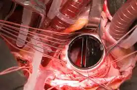 Remplacement de la valve mitrale